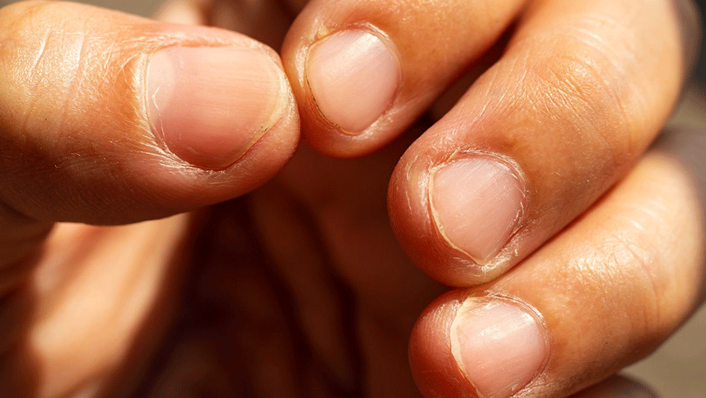 Discoloured fingernail symptom you should get checked out, according to a  doctor - Daily Star